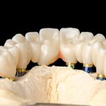 affordable dental crowns bridges pa