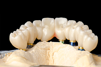 affordable dental crowns bridges pa