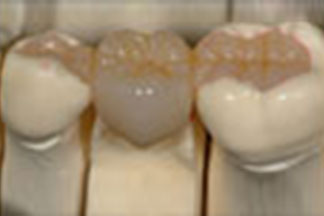 Fixed partial dentures pa