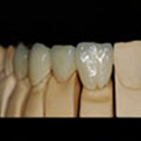 Dental bridges pa
