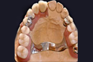 Teeth fixed restorations pa