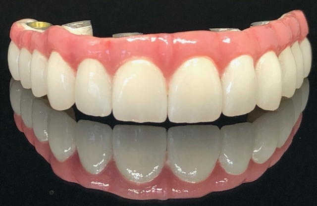 Hybrid implant case featuring a Pekkton frame and multilayered zirconia crowns