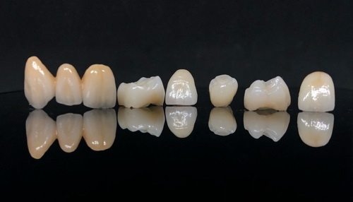 3-unit porcelain fused to metal bridge and porcelain fused to zirconia crowns